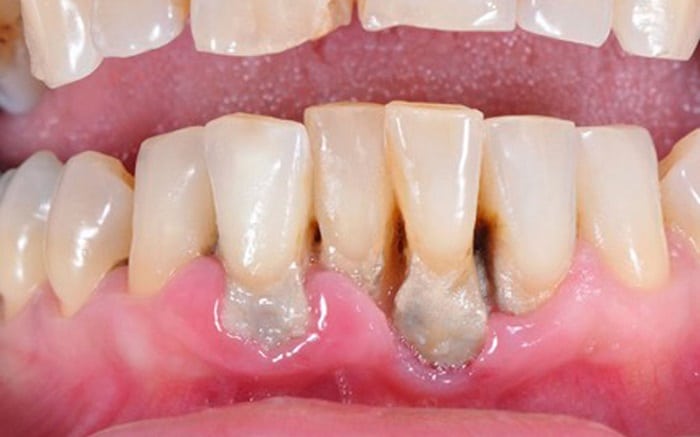 Cao răng được hiểu là
