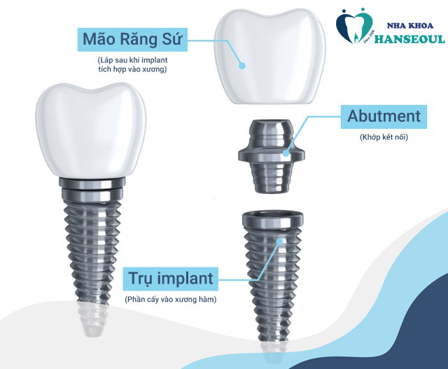 Cấu tạo trụ răng Implant