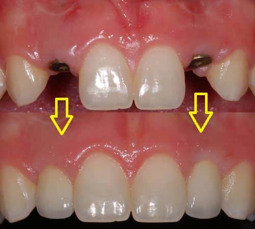 Cấy ghép implant sau khi nhổ răng 3 tháng
