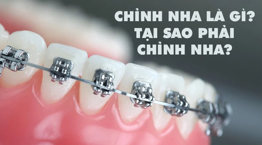 Chỉnh nha là gì