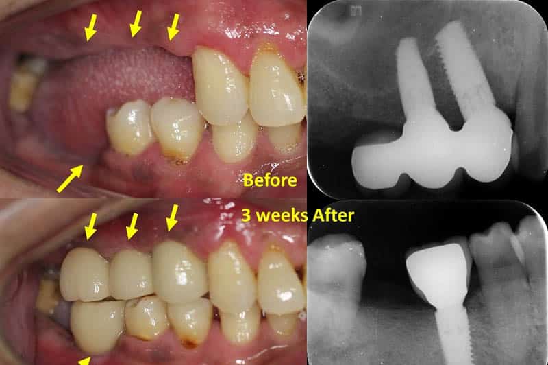 Implant cấy ghép tức thì