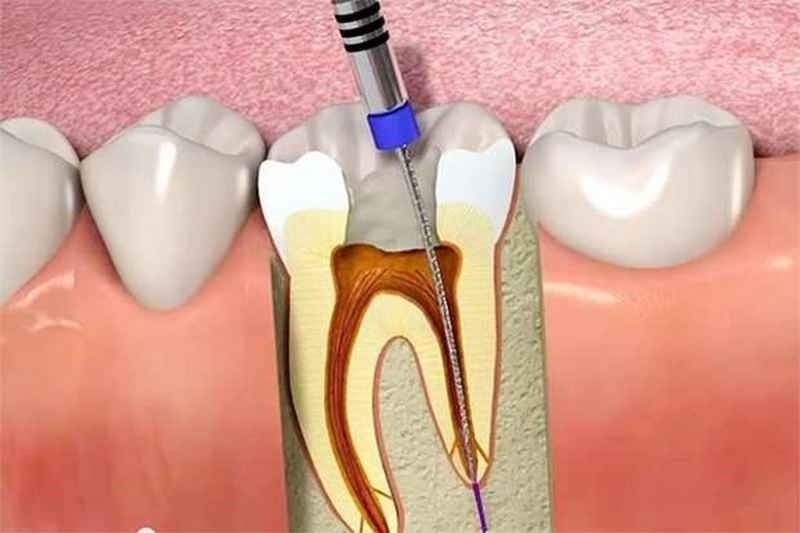 Lấy tủy răng rồi bọc sứ