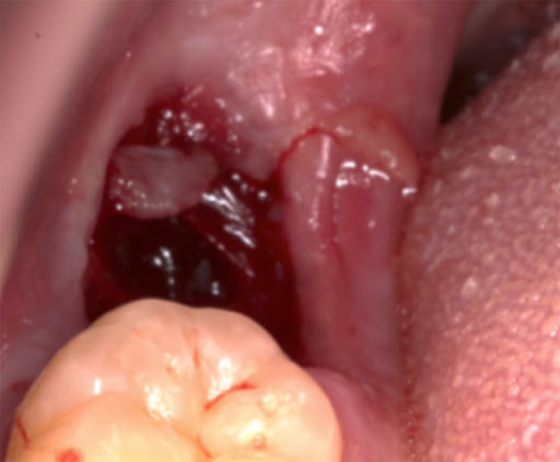 Lỗ sau khi nhổ răng khôn có nguy hiểm không