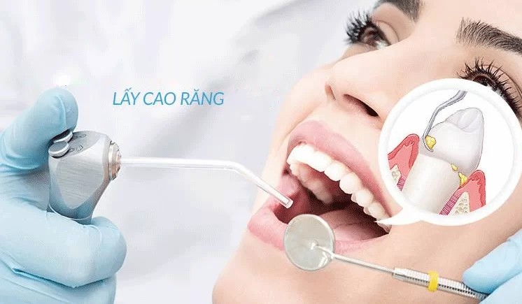 Lợi ích của lấy cao răng định kì