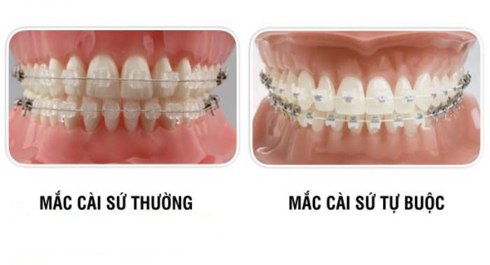 Mắc cài sứ thương và mắc cài sứ tự buộc