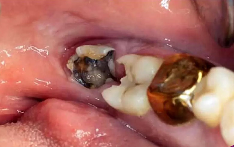 Nguyên nhân răng số 8 bị vỡ