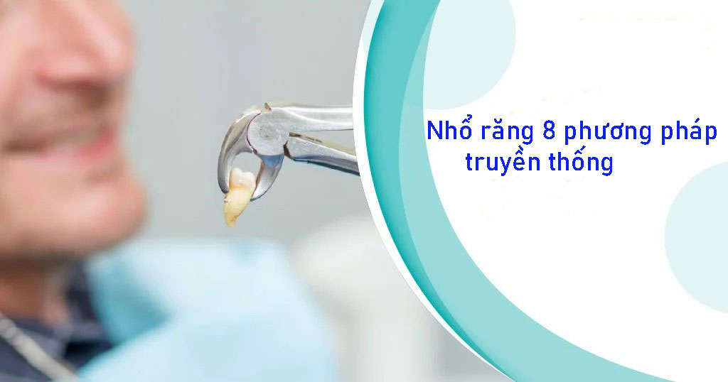 Nhổ răng 8 bằng phương pháp truyền thống