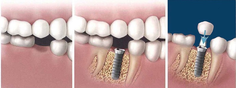 Quy trình trồng răng Implant