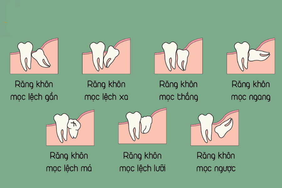Răng số 8 ảnh hưởng răng 7