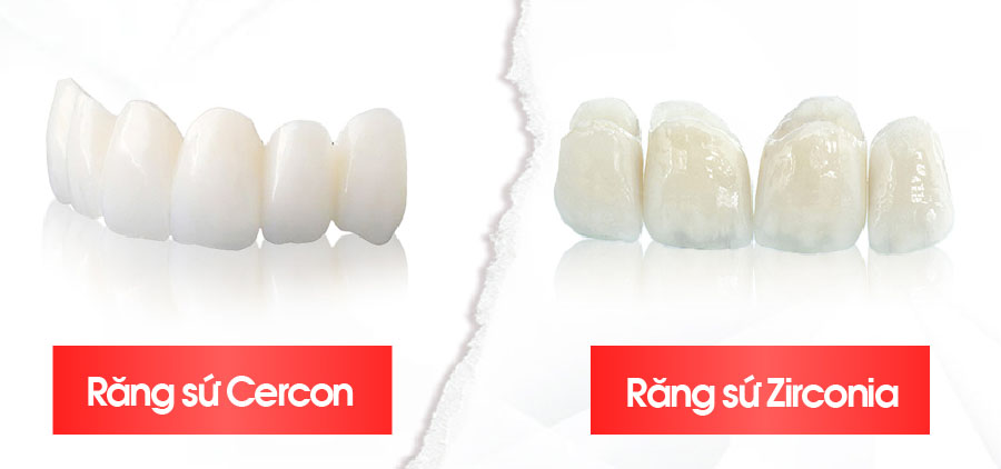 răng sứ Cercon và răng sứ Zirconia