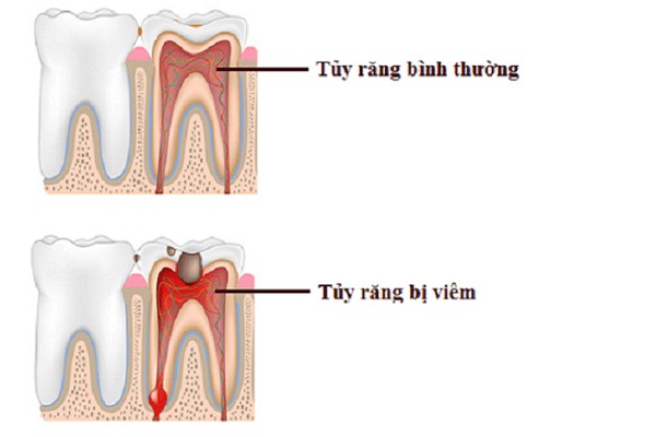 Răng bình thường và răng bị viêm tủy