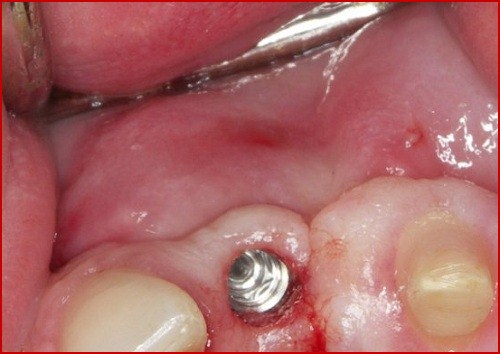  Trồng răng implant chảy máu