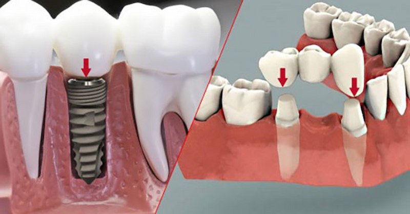 Trồng răng sứ trên trụ implant