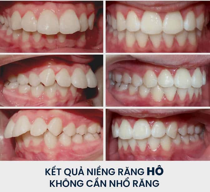 Trước sau niềng răng