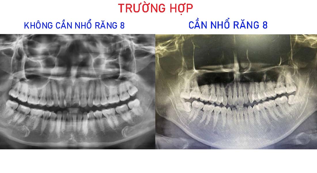 Trường hợp không cần nhổ răng và cần nhổ răng 8