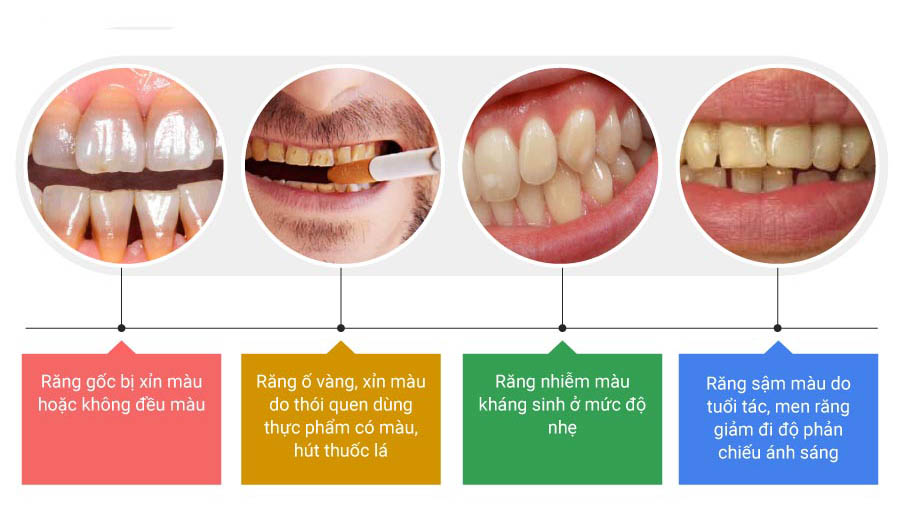 Trường hợp nên tẩy trắng răng