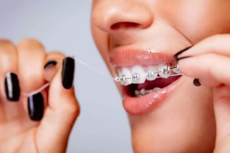 Vệ sinh răng miệng khi niềng