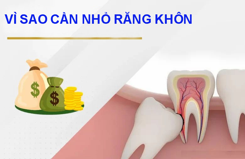 Vì sao cần nhổ răng khôn
