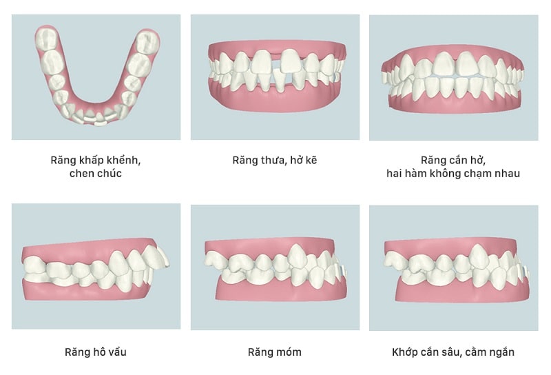 Các trường hợp cần niềng răng