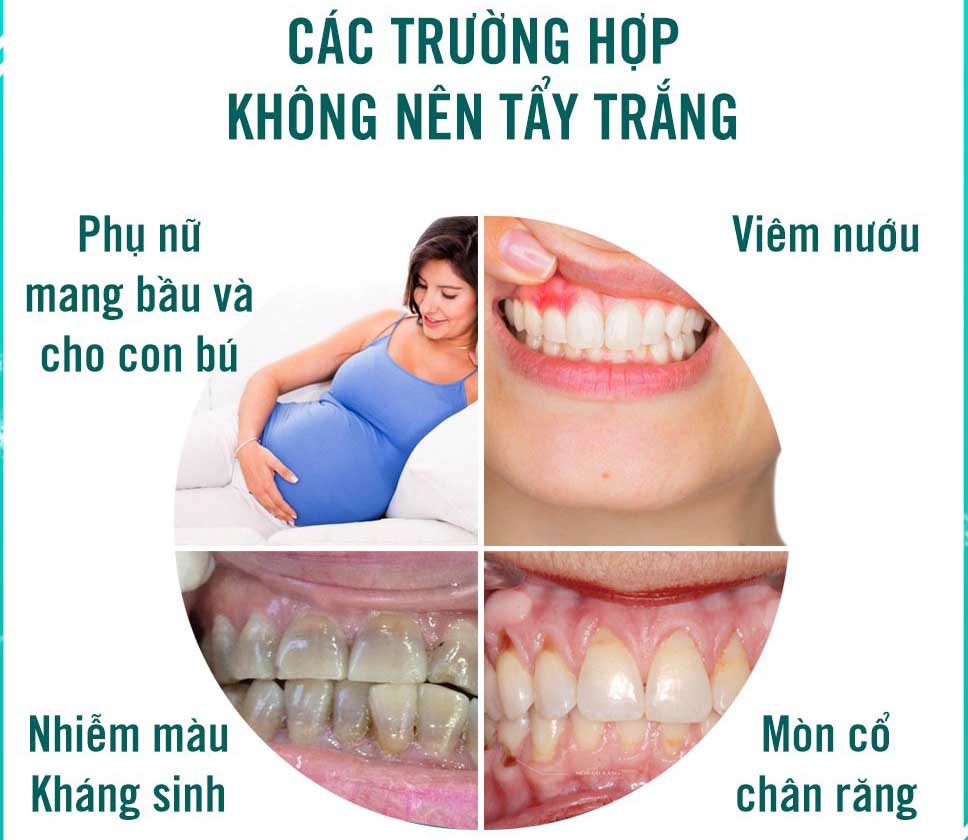 Các trường hợp không nên tẩy trắng răng