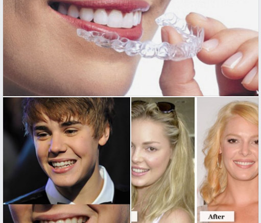 Invisalign cùng người nổi tiếng