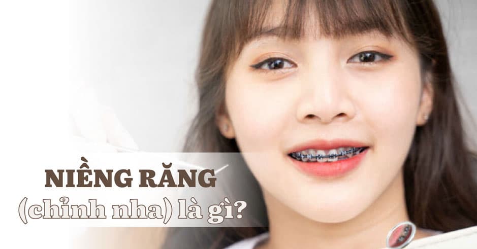 Niềng răng chỉnh nha la gì