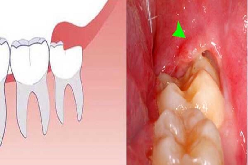 Răng số 8 bị sâu vỡ