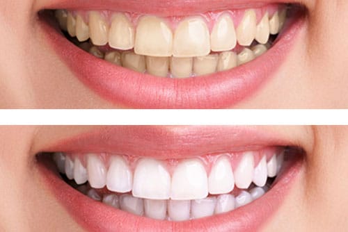 Tẩy trắng răng giúp hàm răng trở nên trắng sáng, nụ cười tự tin hơn