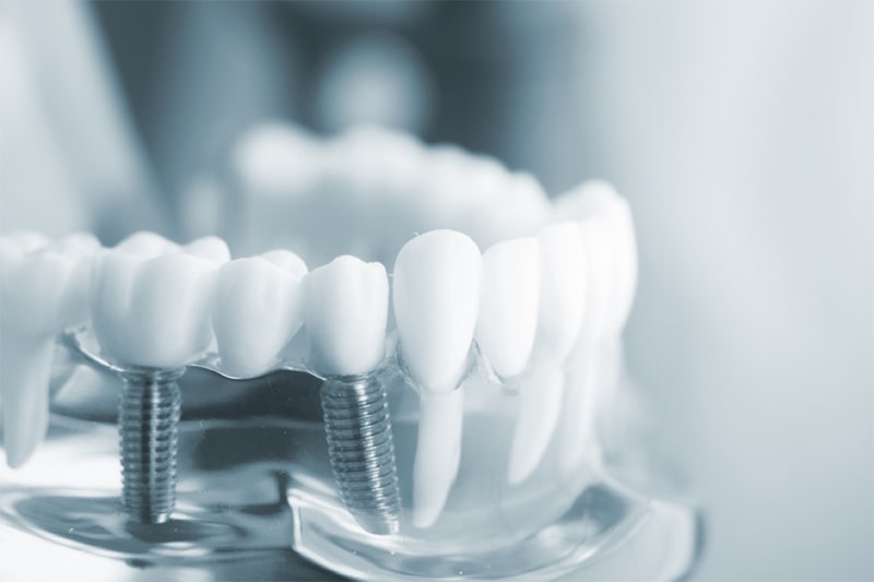 Trồng răng implant trả góp