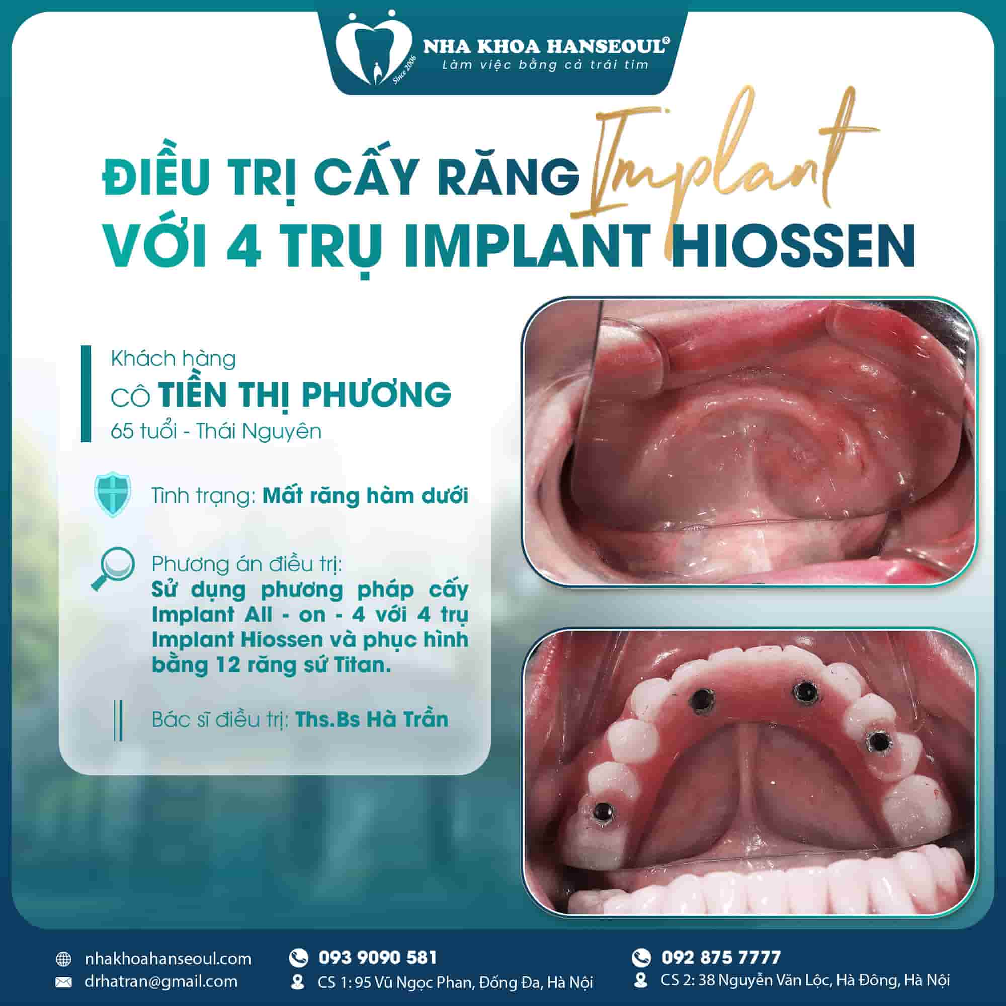 hiossen implant 2