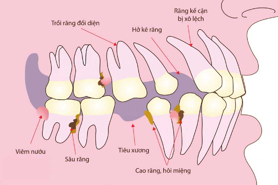 tieu xuong rang 1658221149279775467459