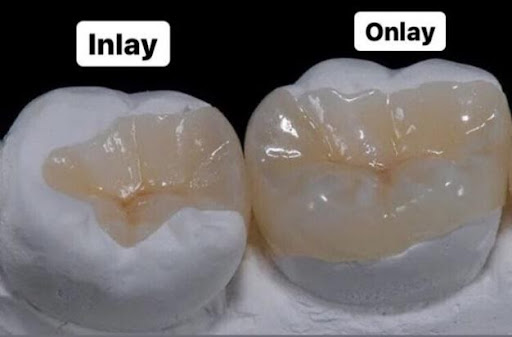 inlay onlay sứ