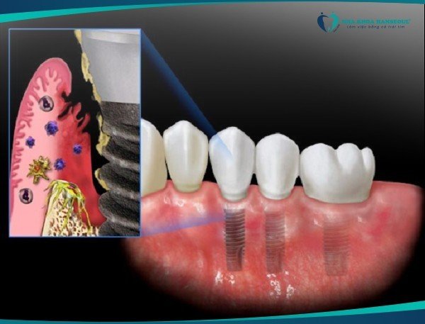 viêm quanh trụ implant do trồng implant giá rẻ