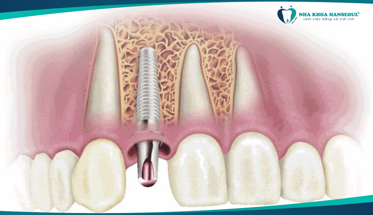 hối hận khi trồng implant giá rẻ