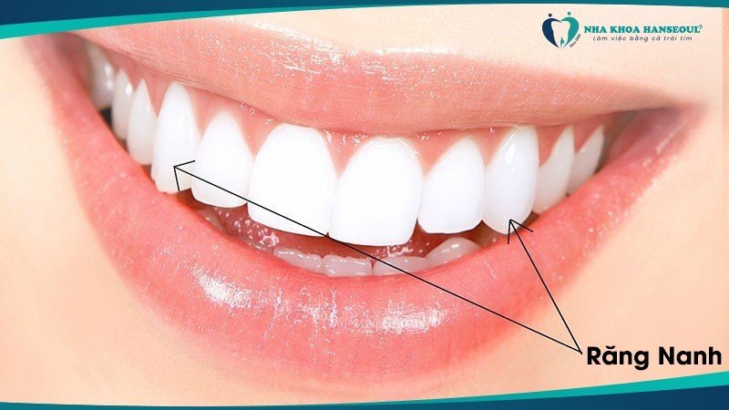 răng nanh là gì