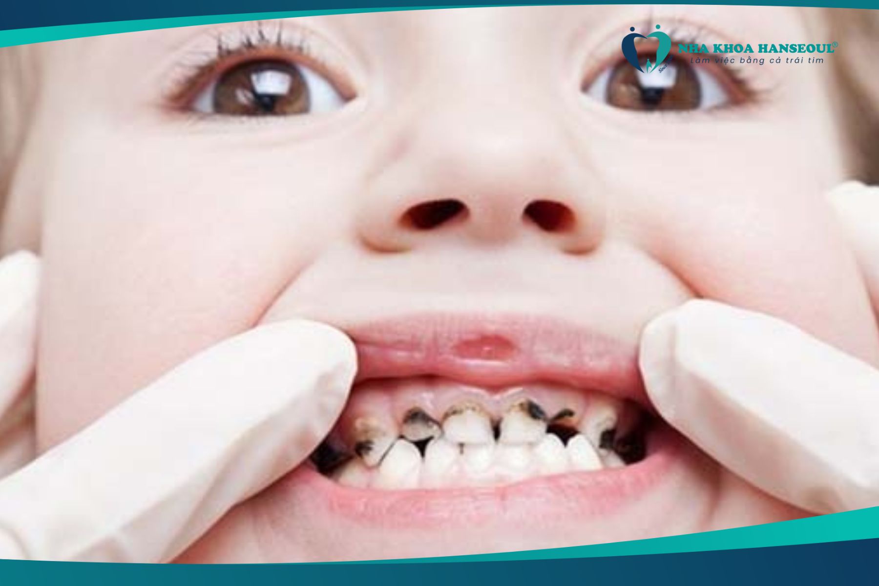 Trẻ bị sâu răng do sử dụng kháng sinh