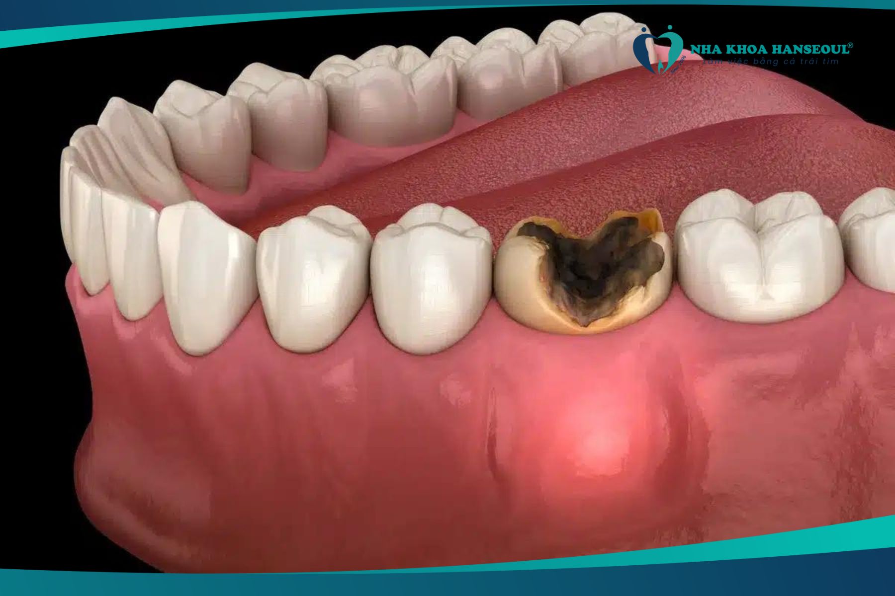 Sâu răng nặng dẫn đến áp xe răng
