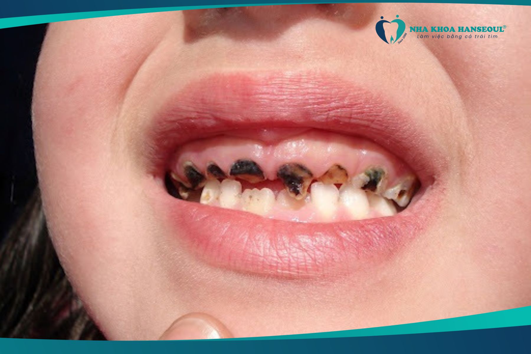 Tình trạng sâu răng quá nặng ở trẻ