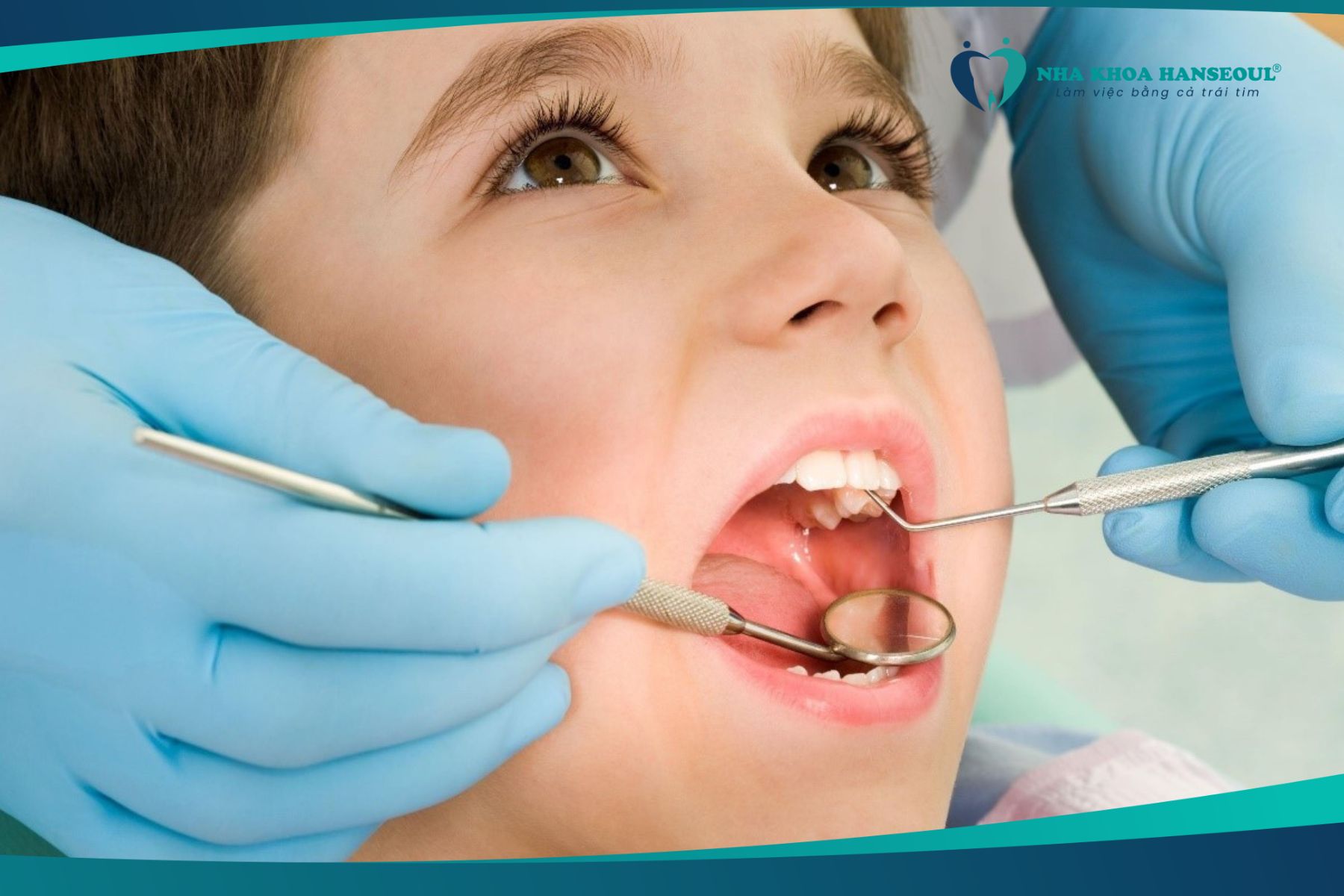 Tình trạng sâu răng hàm ở trẻ