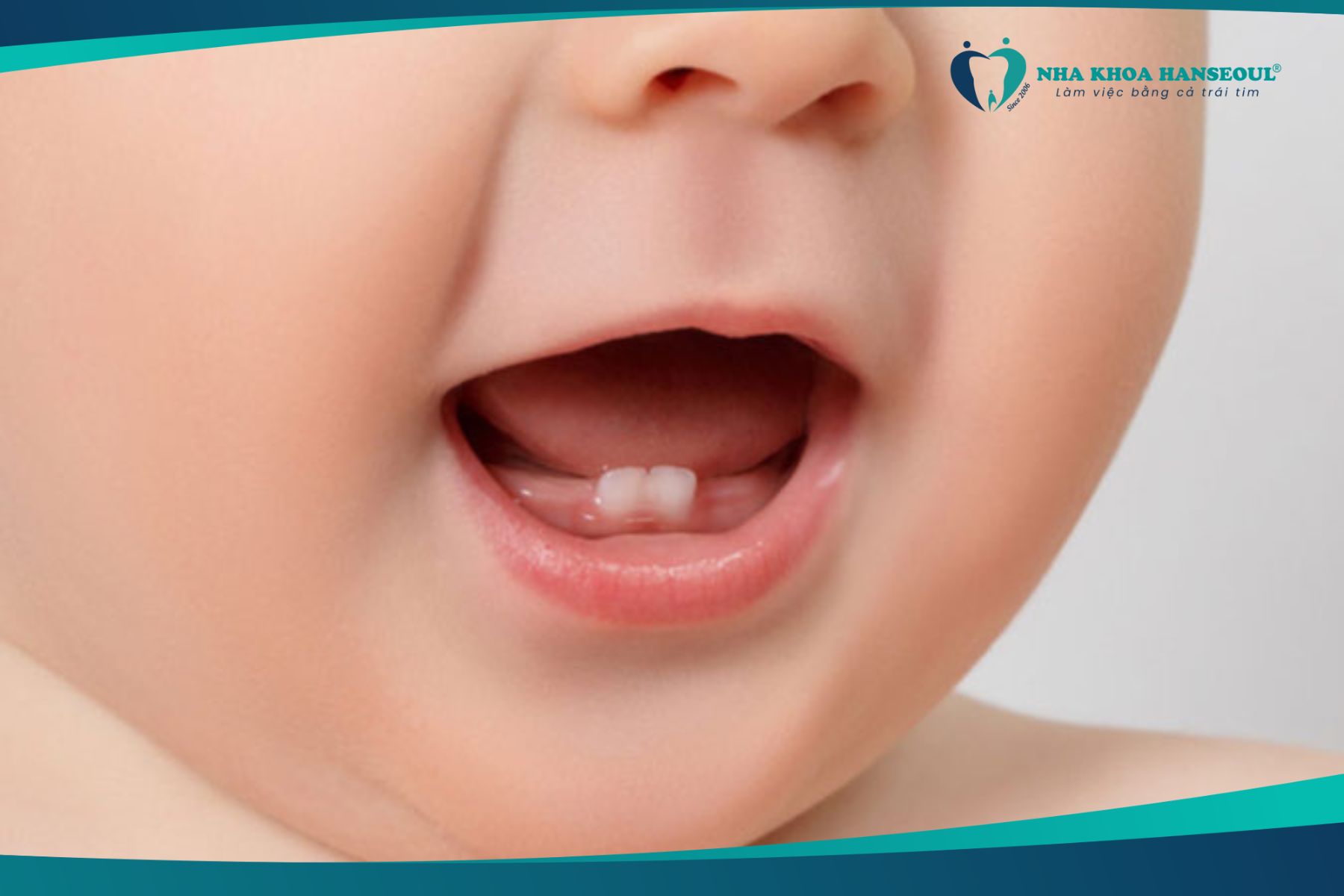 Lưu ý khi chữa nghiến răng cho trẻ mọc răng