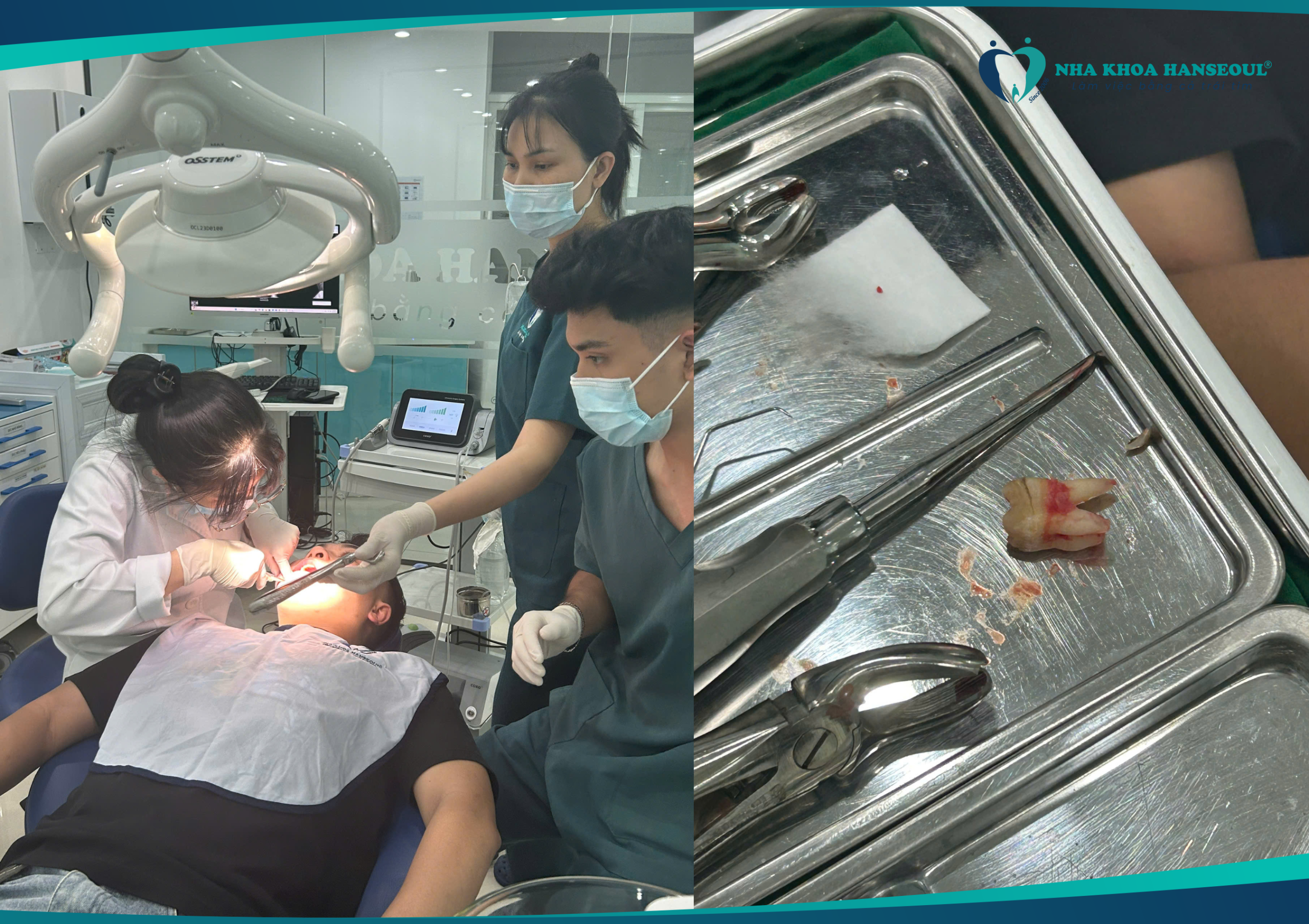 Nhổ răng khôn không đau, không sưng tại Nha khoa Hanseoul

