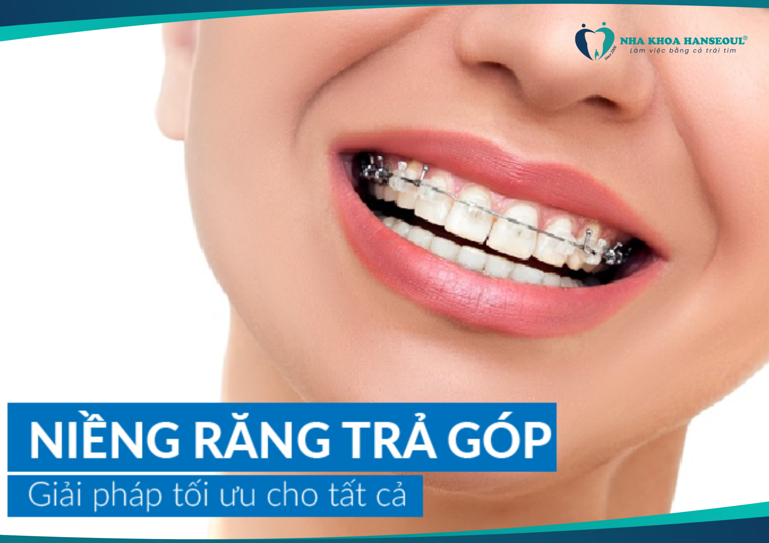 Niềng răng trả góp giúp bạn giảm gánh nặng kinh tế

