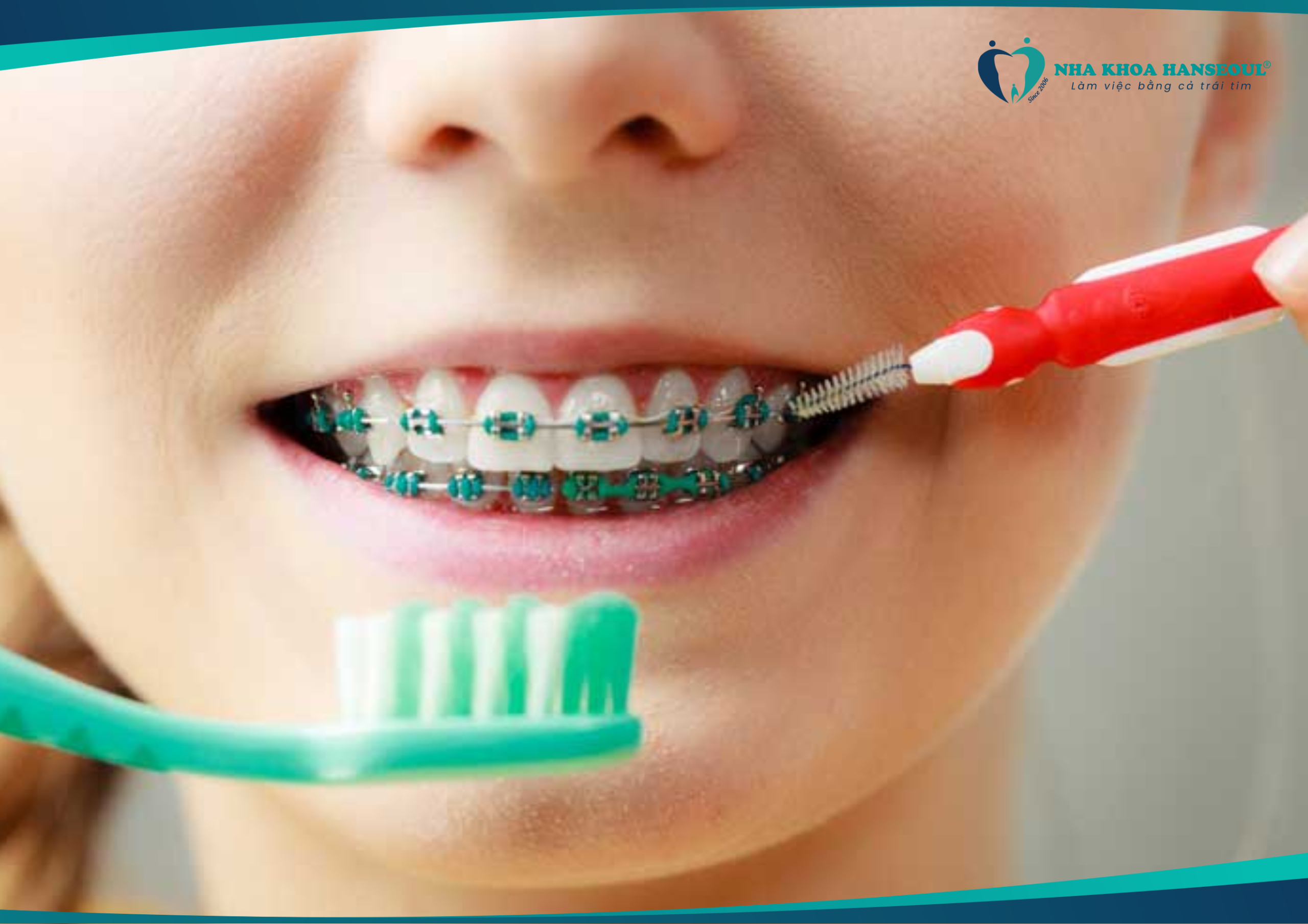 Vệ sinh răng miệng đều đặn 2-3 lần/ngày để có kết quả chỉnh nha hoàn hảo nhất 