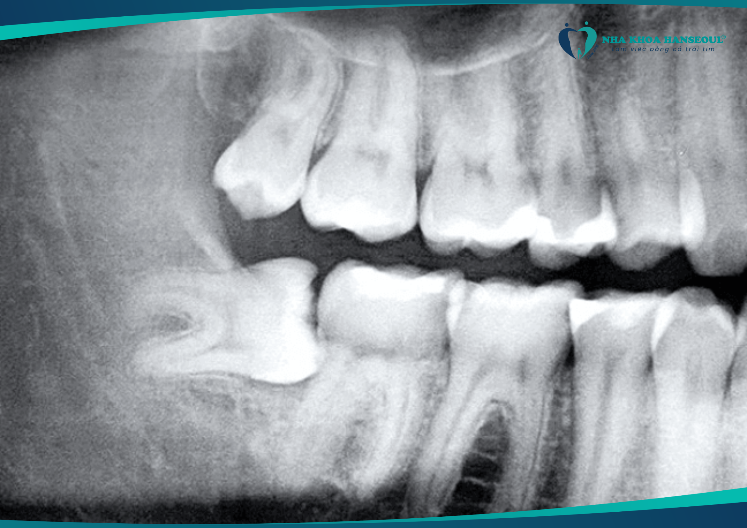 Răng khôn mọc lệch cần được nhổ để tránh gây các biến chứng nguy hiểm 