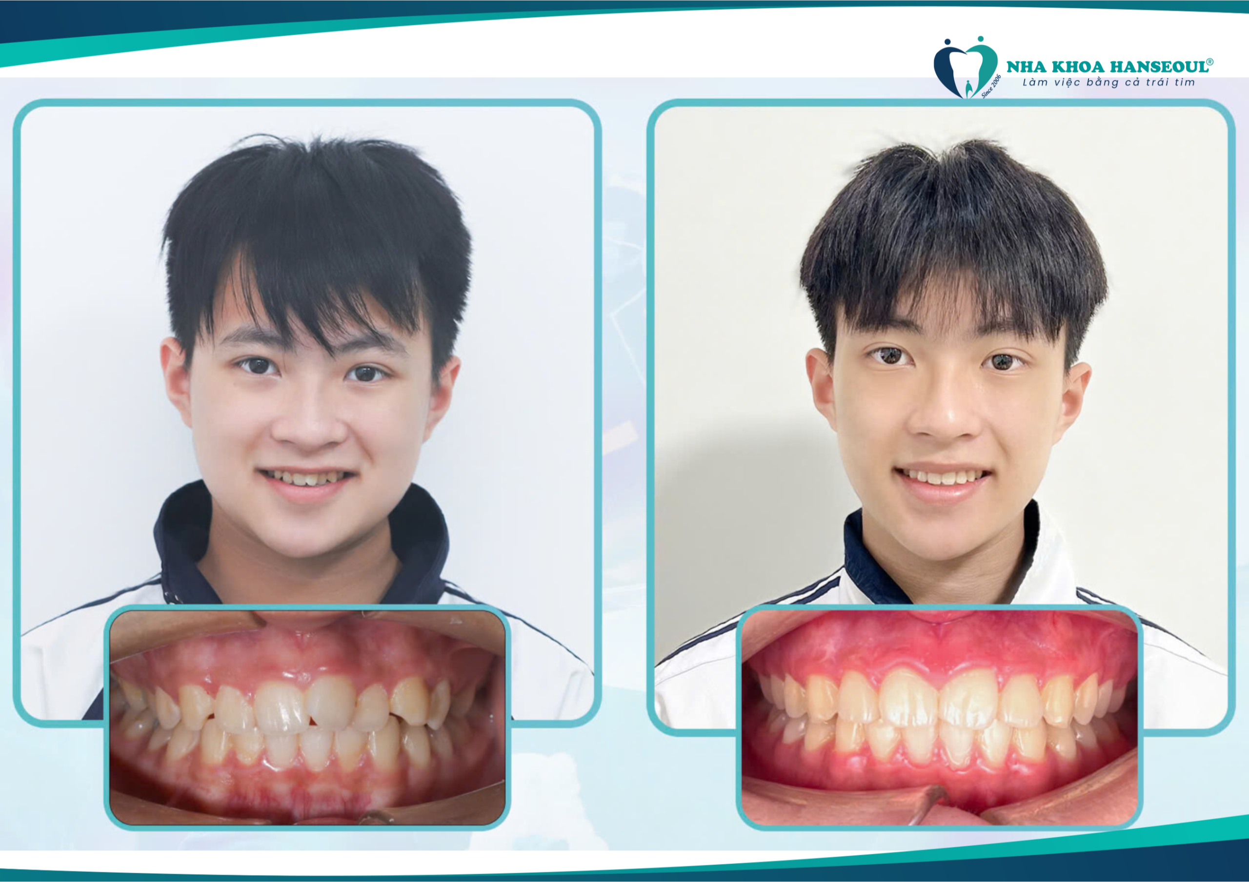 Niềng răng với công nghệ BioSmart tại Nha khoa Hanseoul giúp việc điều chỉnh răng chính xác hơn và giảm thiểu đau đớn. 