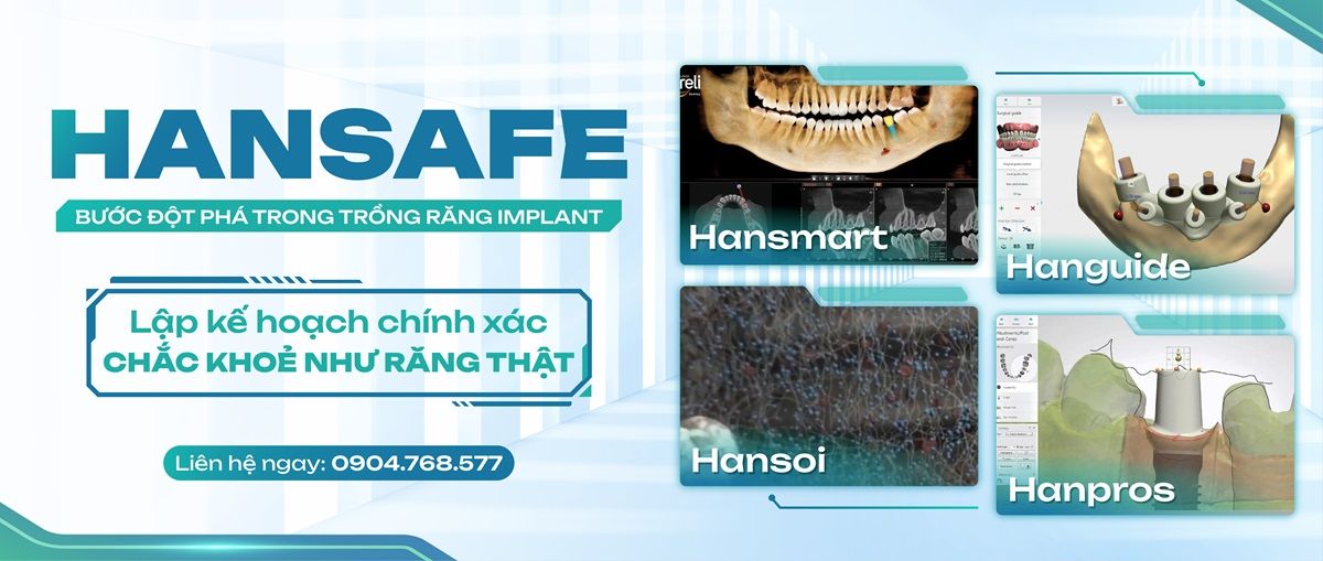 Công nghệ trồng răng Hansafe tại Nha khoa Hanseoul Công nghệ trồng răng Hansafe tại Nha khoa Hanseoul