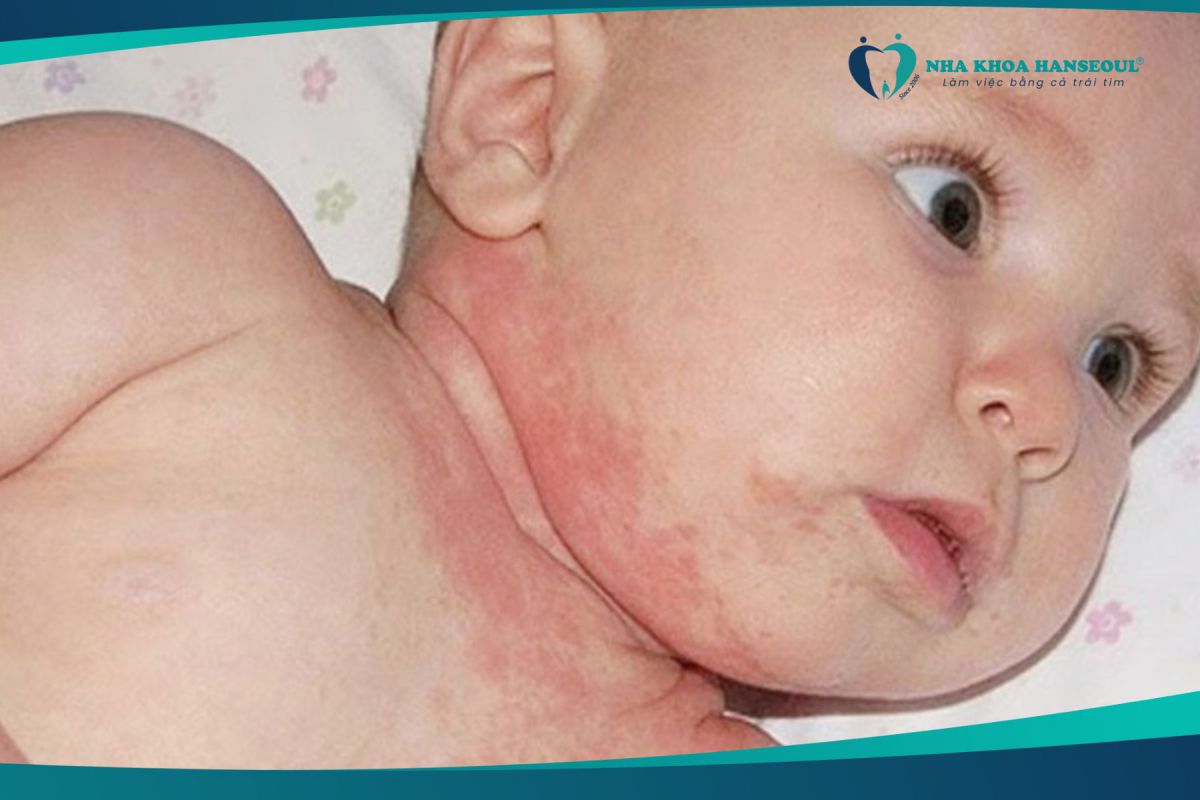 Trẻ nghiến răng vì bị dị ứng