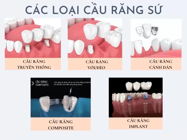 các loại cầu răng sứ