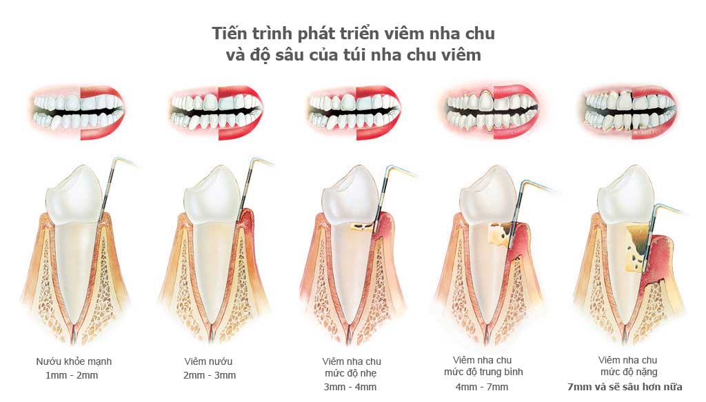 Bệnh viêm nha chu Bệnh viêm nha chu