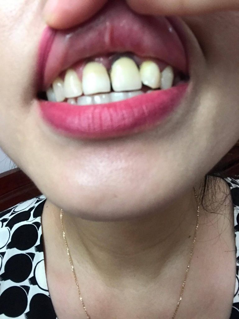 Bọc răng sứ giá rẻ hậu quả Bọc răng sứ giá rẻ hậu quả